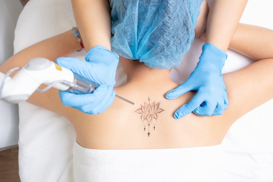 Laser Tattoo