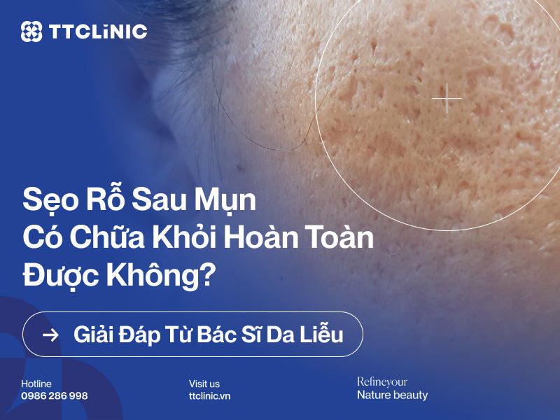 Sẹo rỗ sau mụn có chữa khỏi hoàn toàn được không? Giải đáp từ Bác sĩ Da liễu