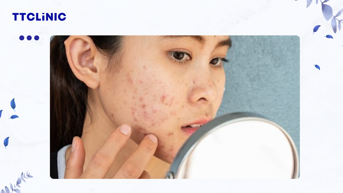 Cách trị thâm mụn: Mẹo hết thâm mụn trong 1 tuần