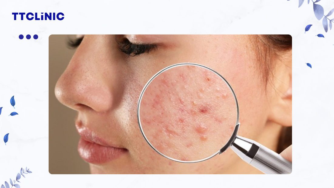 Mụn ẩn: Dấu hiệu, nguyên nhân và cách điều trị hiệu quả