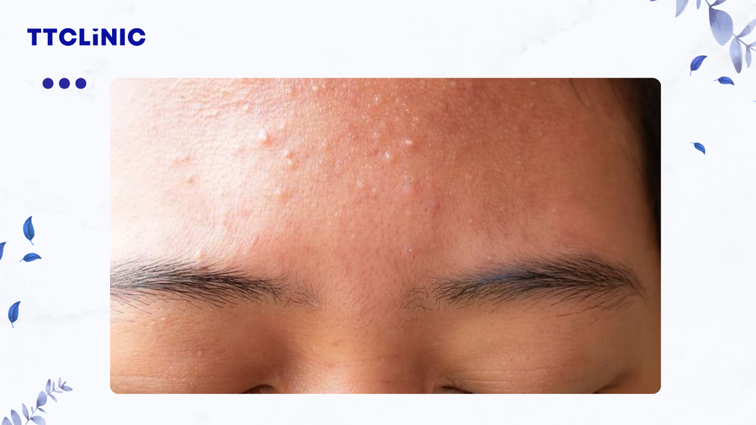 Mụn ẩn ở trên trán: 3 cách điều trị hiệu quả ai cũng làm được