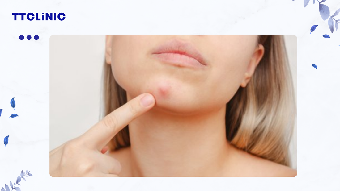 Mụn dưới cằm: Cách điều trị dứt điểm, không tái phát