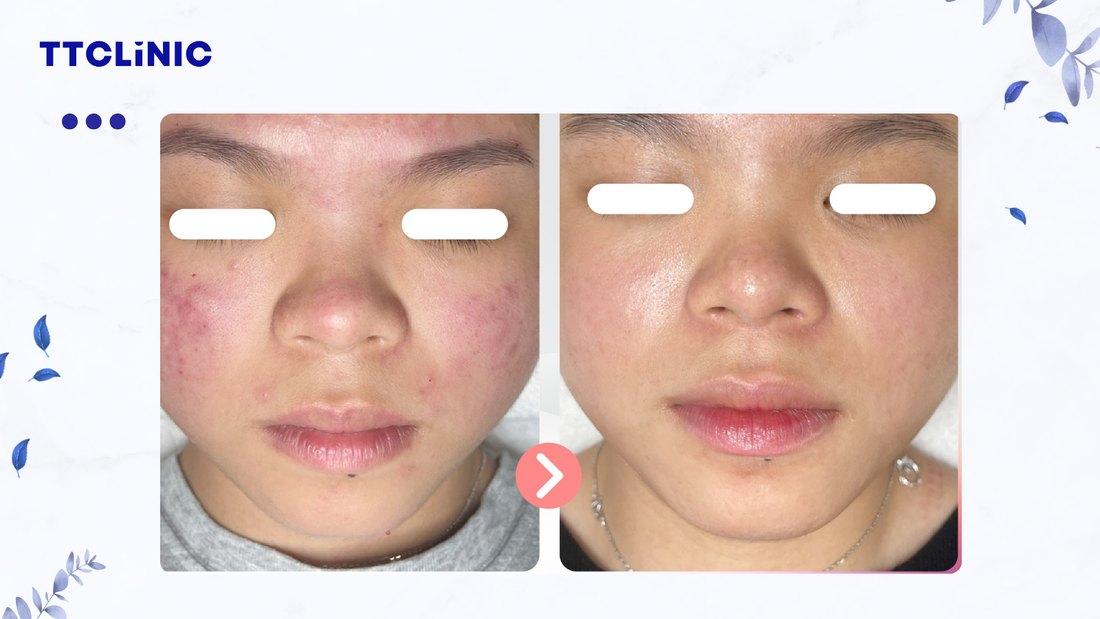 Mụn viêm: Giải pháp điều trị mụn viêm chuẩn y khoa