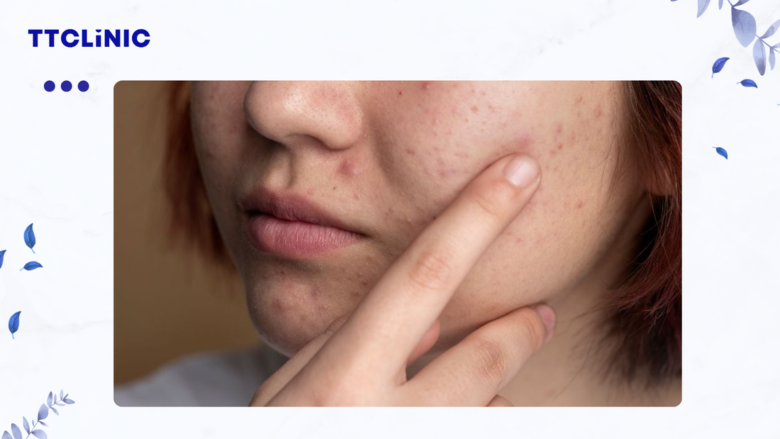 Nguyên nhân gây mụn viêm phổ biển cần hiểu đúng để điều trị hiệu quả