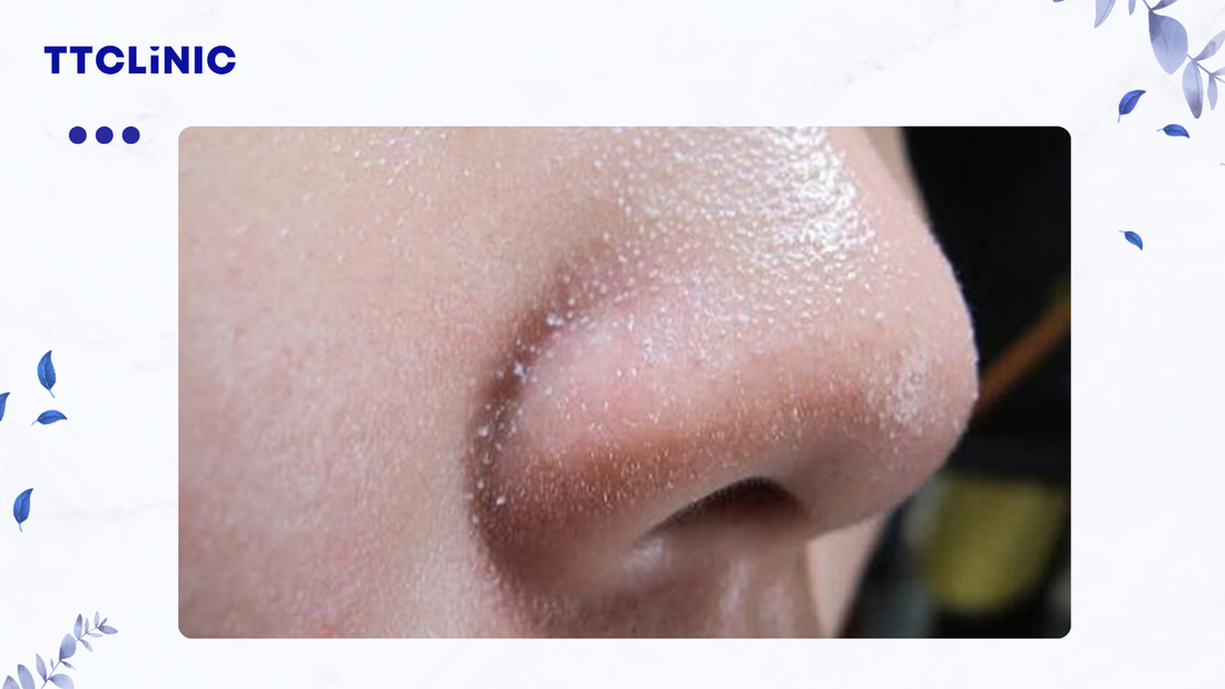 5 cách loại bỏ sợi bã nhờn giúp làn da luôn mịn màng, sạch thoáng